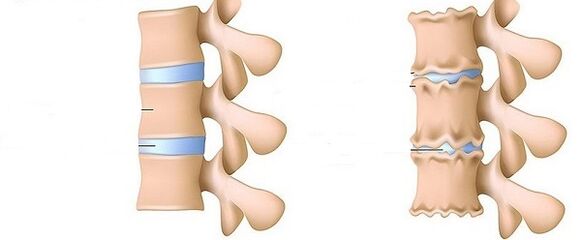unha columna vertebral saudable e osteocondrose