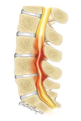 Coa osteocondrose da columna vertebral torácica, prodúcese a compresión da canle espiñal