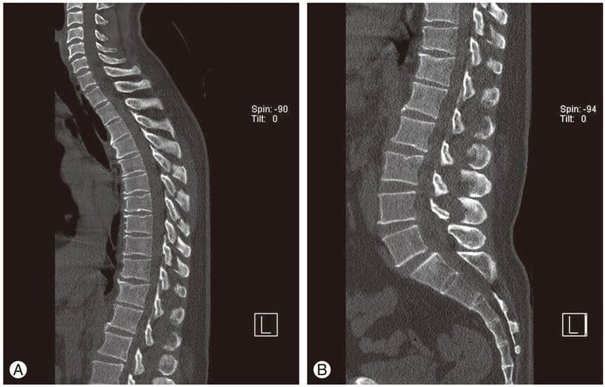 Deformación dos discos intervertebrais en imaxes de resonancia magnética na osteocondrose torácica