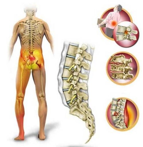Osteocondrose da columna lumbar, causando dor nas costas