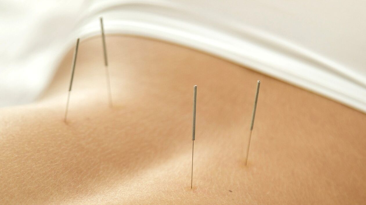 A acupuntura axudará a desfacerse da dor lumbar
